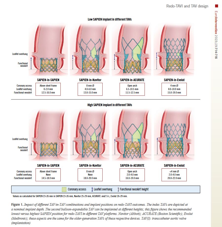 Redo-TAVI outcomes are influenced by initial TAV design, implantation depth, and neoskirt height, impacting coronary access and valve performance. This study examines these factors to optimize long-term management for patients requiring TAV-in-TAV procedures. #Cardiology #TAVI
