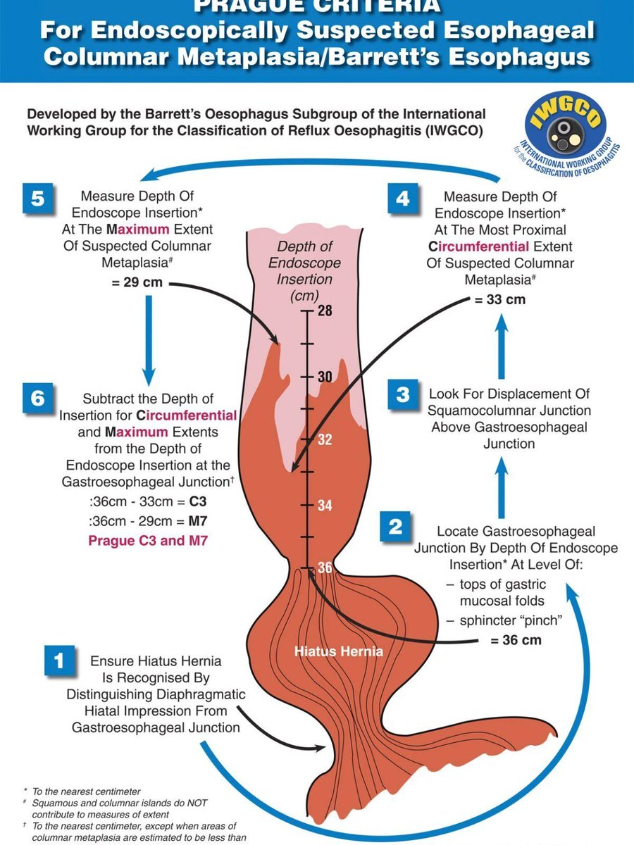 Prague Criteria for the Categorization of Barrett's Esophagus