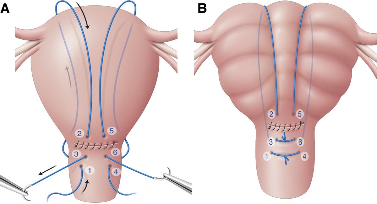 AJOG Expert Review in Labor:  Uterine-sparing surgical procedures to control postpartum hemorrhage - Bhal’s uterine compression technique ow.ly/tqgu50U3Guk
