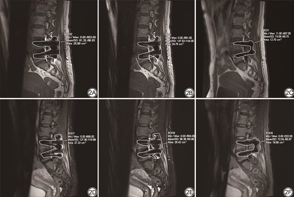 CJMRI_2010's tweet photo. Compared with #HBW and Dixon sequences, #CS-SEMAC sequence can effectively reduce the metal artifacts around the implant, and significantly improve the image quality and fat inhibition effect of T2 lipid suppression sequence. 
https://t.co/cSjbI87ZW8 https://t.co/nJDxrmzivT