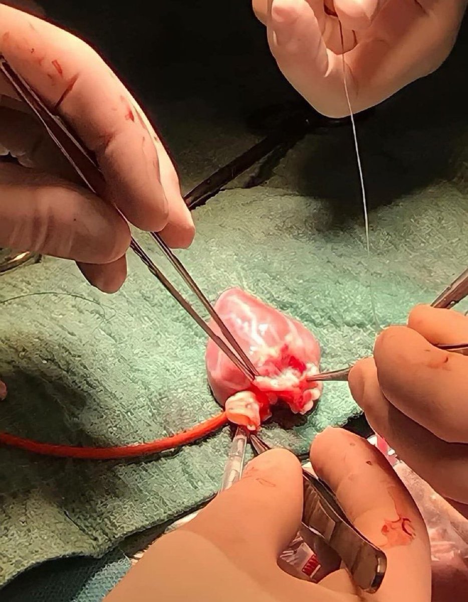 The youngest heart transplant performed was on a newborn  6 days old! These tiny hearts can be as small as a walnut, with blood vessels measuring just a few millimeters in diameter. Take a look at the image below showcasing a pediatric heart transplant.🫀🫀