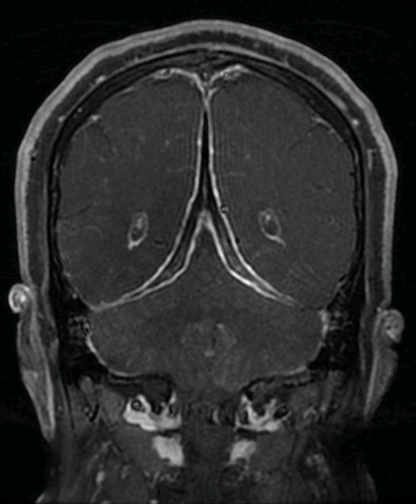 PouriaMoshayedi's tweet photo. "Eiffel-by-Night" sign in a patient with idiopathic hypertrophic pachymeningitis. Brain, T1 sequence post contrast, coronal section. 

Patient of Dr Mohammadiani-Nejad at #IKHC, @TehUofMed 

@ContinuumAAN @TheASNR @theneuroradguy @Neuroradbites @AANmember @teachplaygrub https://t.co/9jmsn0w26R