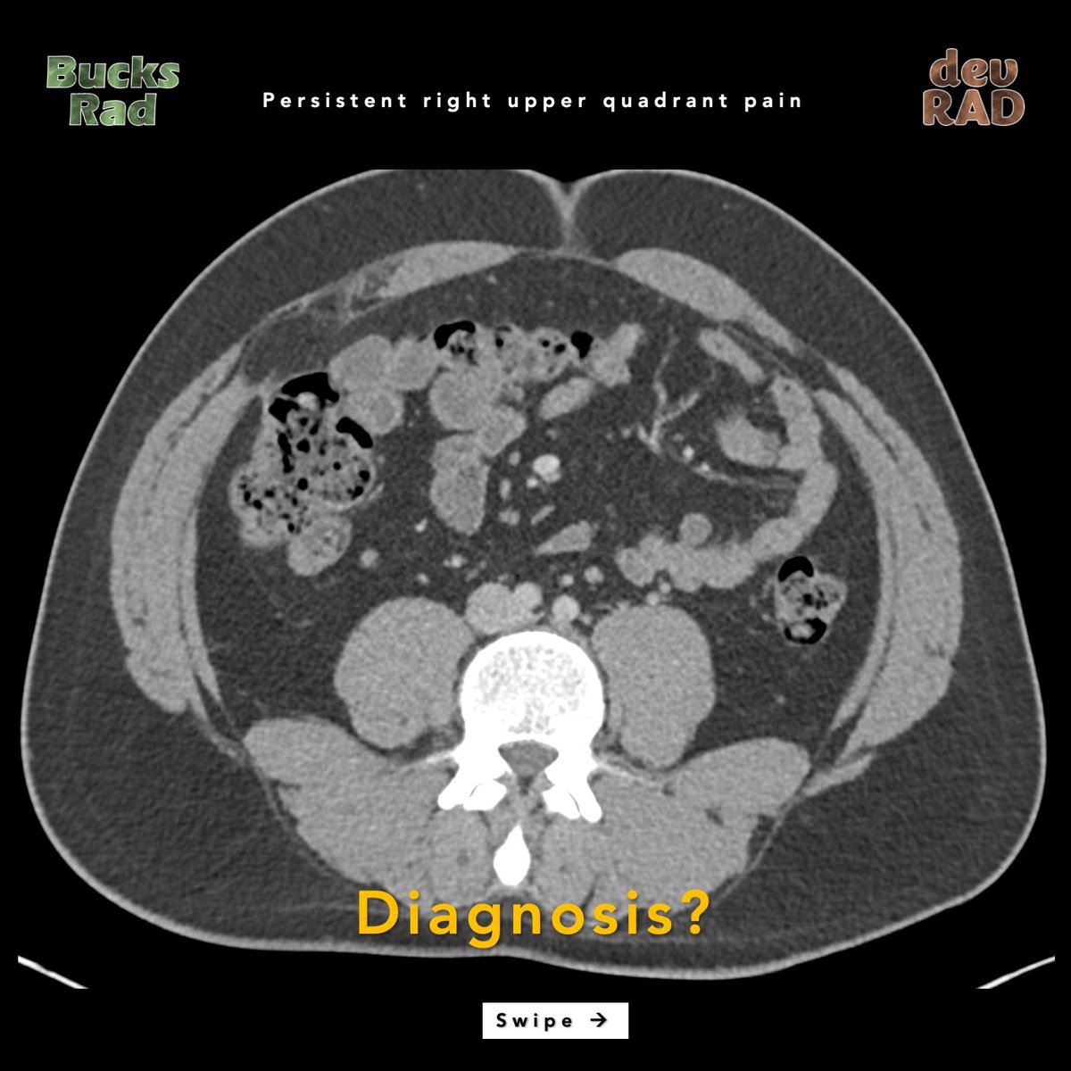 🚨Let’s take a look at an unusual type of hernia.

Can you see the finding here?

#MEDTwitter