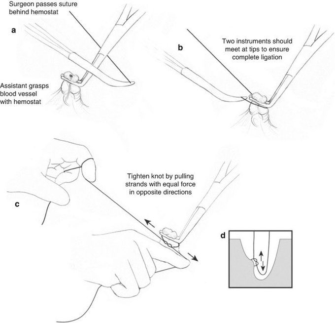 PipeCabreraV's tweet photo. Vascular ligation: how to do it! Key: Tying the knot 🪢 down using your index finger putting your power over the knot and not in the tissue ⤵️! @pferrada1 @SWexner @juliomayol @Cirbosque @rbarbosa91 @TomVargheseJr @NeilFlochMD @sminaev2015 @drdevirgilio @David_ukan @BBASS_skills https://t.co/AxMFWeBGbn