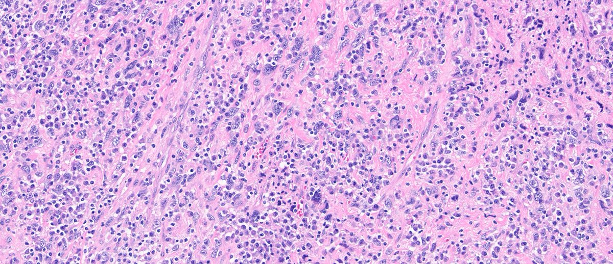panJackson3's tweet photo. Mass from heart. What's your impression by morphology? #PathTwitter https://t.co/L8QgFduWXu