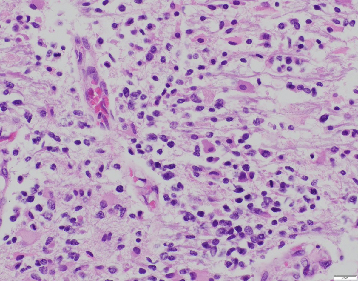 bitar_mireille's tweet image. Diffuse midline #glioma H3 K27-altered WHO grade 4. Diagnostic criteria for subtypes:
-K27M mutation in one of the H3 isoforms
- Overexpression of EZHIP (H3-wt)
- EGFR mutation or amplification
-Methylation profile of one of the subtypes 
#pedipath #neuropath #pathology