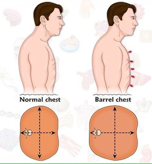 Sh31n5's tweet photo. @iirode0 Barrel chest   هو مرض يصير بالرئه يخليها لقدام https://t.co/cO5uOpZwj0