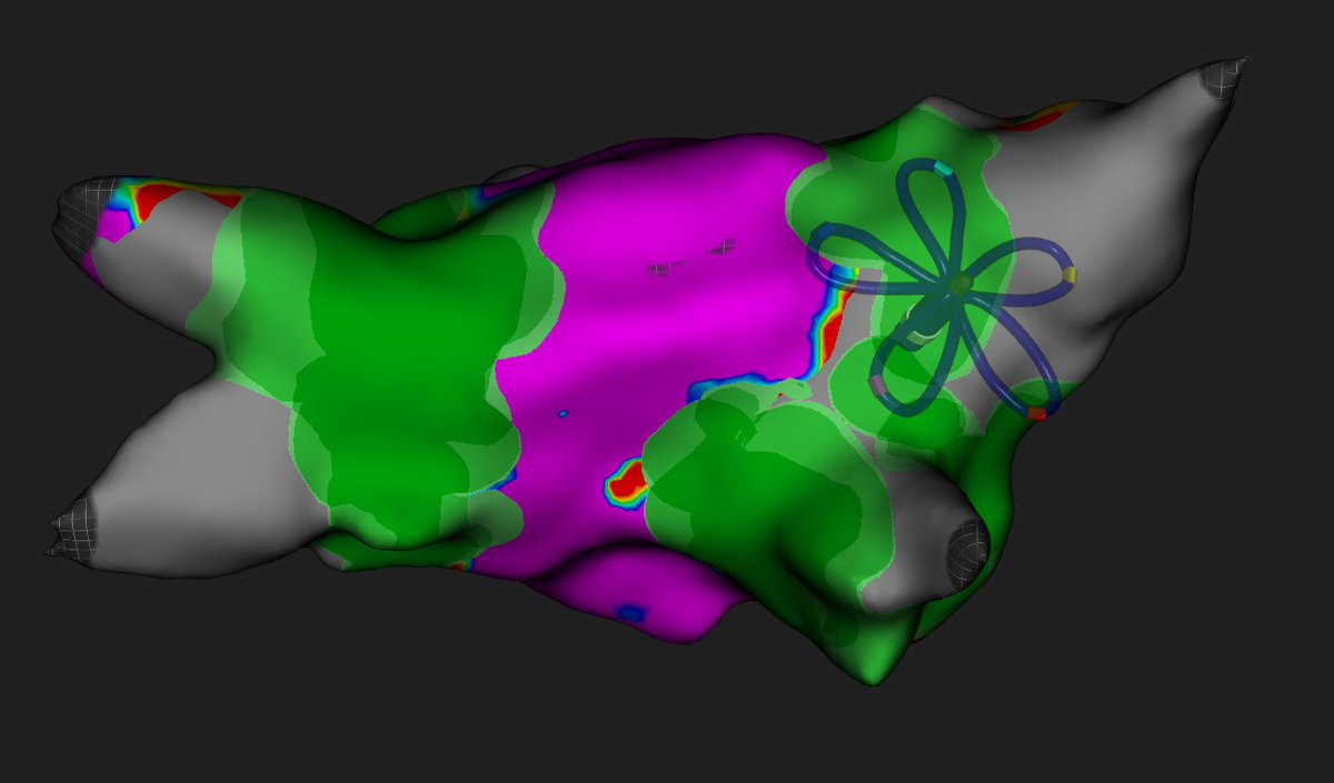 weiner_s's tweet photo. It was great to do several cases with FARAVIEW software and FARAWAVE NAV catheters. Real-time visualization with no catheter exchanges really helps with procedural workflow. 
#EPeeps https://t.co/692D2s9lGu