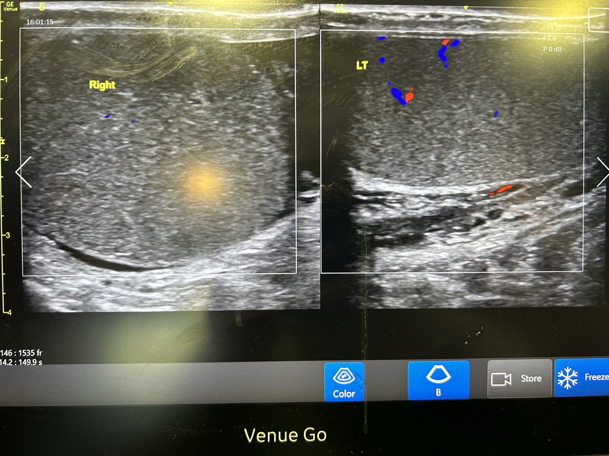 khldtaha's tweet photo. POCUS of the Week 
 Great service offered by Art of emergency medicine  ( POCUS ) to save precious organs in the ED
Young man 30, in triage at 13:58 sudden sever Rt sided testicular pain 3 hours ago , Triage nurse brought him ,immediate POCUS showed RT testicular torsion https://t.co/i4qpHrRWW3
