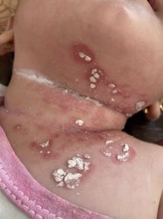 Eng_Fayez_j's tweet photo. 🚨URGENT🚨
Skin diseases are devastating the bodies of my daughter.We dK what they're &amp; where they come from. my daughter is in grave danger.
Help us,please.There's no health care, no sterilizers &amp; no treatments Help my daughter to get out of this hell🥺💔
https://t.co/Zz6iE6XNF5 https://t.co/lnrP2Psat4