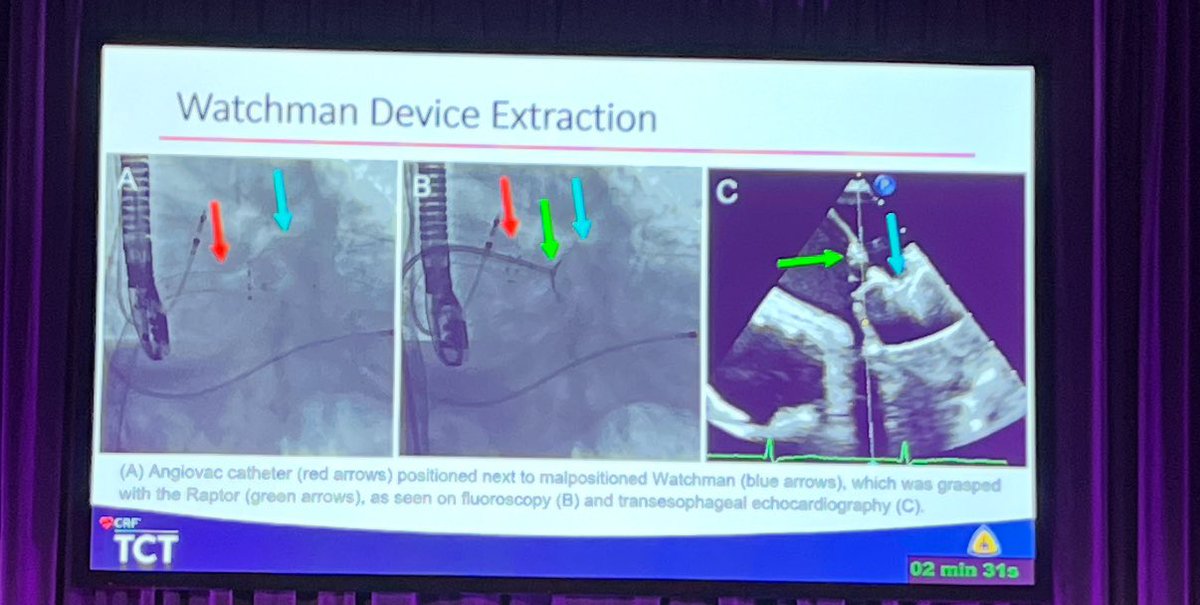 Hooman Bakhshi (@bakhshihooman) on Twitter photo My friend and former cofellow <a href="/sumonroy_md/">sumonroy</a> presents a case of failed Watchman which was removed by a Raptor and replaced with an Amulet. #TCT2024 <a href="/crfheart/">Cardiovascular Research Foundation</a> #CardioTwitter <a href="/frahman480/">Dr. Faisal Rahman</a> <a href="/RaniKHasan/">Rani Hasan</a> My friend and former cofellow <a href="/sumonroy_md/">sumonroy</a> presents a case of failed Watchman which was removed by a Raptor and replaced with an Amulet. #TCT2024 <a href="/crfheart/">Cardiovascular Research Foundation</a> #CardioTwitter <a href="/frahman480/">Dr. Faisal Rahman</a> <a href="/RaniKHasan/">Rani Hasan</a>