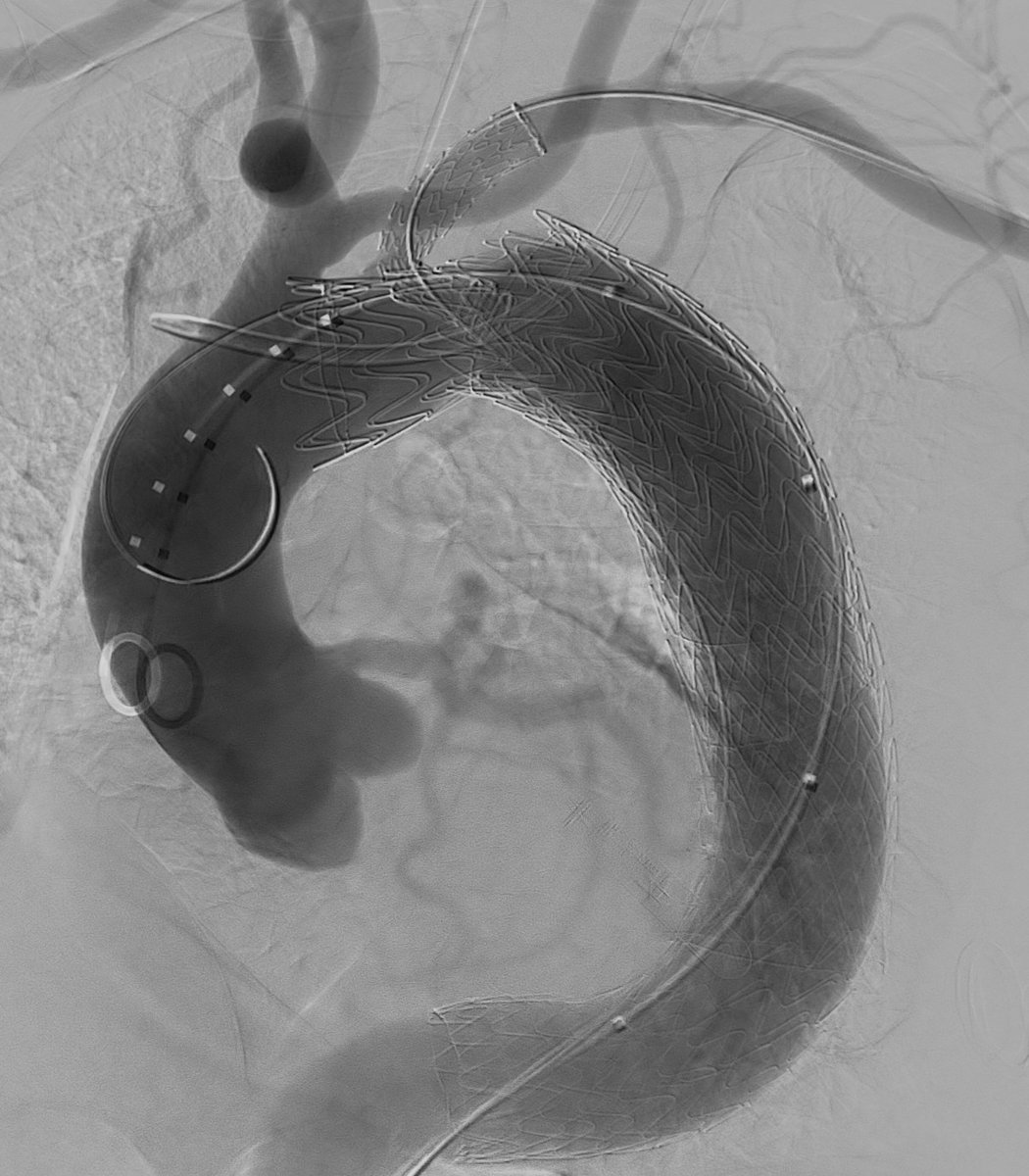 Miami Vascular (@miamivasc) on Twitter photo Big type IA and IB endoleaks in an infected aneurysm sac post TEVAR 2 years ago. Treated by <a href="/AlexPowellMD1/">Alex Powell,MD</a>, <a href="/schiro_md/">Brian J. Schiro, MD</a>, <a href="/AbnerWilding/">Abner David Wilding</a> with thoracic branched endograft with excellent results! Ideal treatment would be surgery for infection but not a surgical pt. <a href="/SIRRFS/">SIR RFS</a> #MedEd Big type IA and IB endoleaks in an infected aneurysm sac post TEVAR 2 years ago. Treated by <a href="/AlexPowellMD1/">Alex Powell,MD</a>, <a href="/schiro_md/">Brian J. Schiro, MD</a>, <a href="/AbnerWilding/">Abner David Wilding</a> with thoracic branched endograft with excellent results! Ideal treatment would be surgery for infection but not a surgical pt. <a href="/SIRRFS/">SIR RFS</a> #MedEd