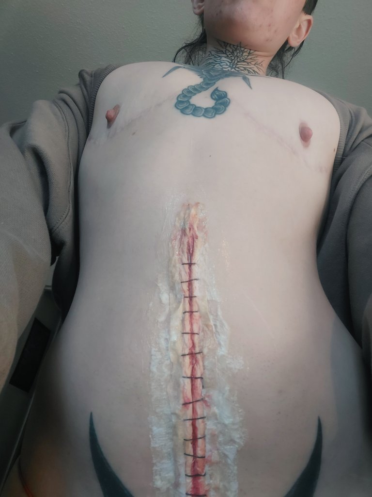 tinyholeboy's tweet photo. Had to stop mid application bc my tummy just looked so cute all stitched up 🪡 https://t.co/ydUc02savP