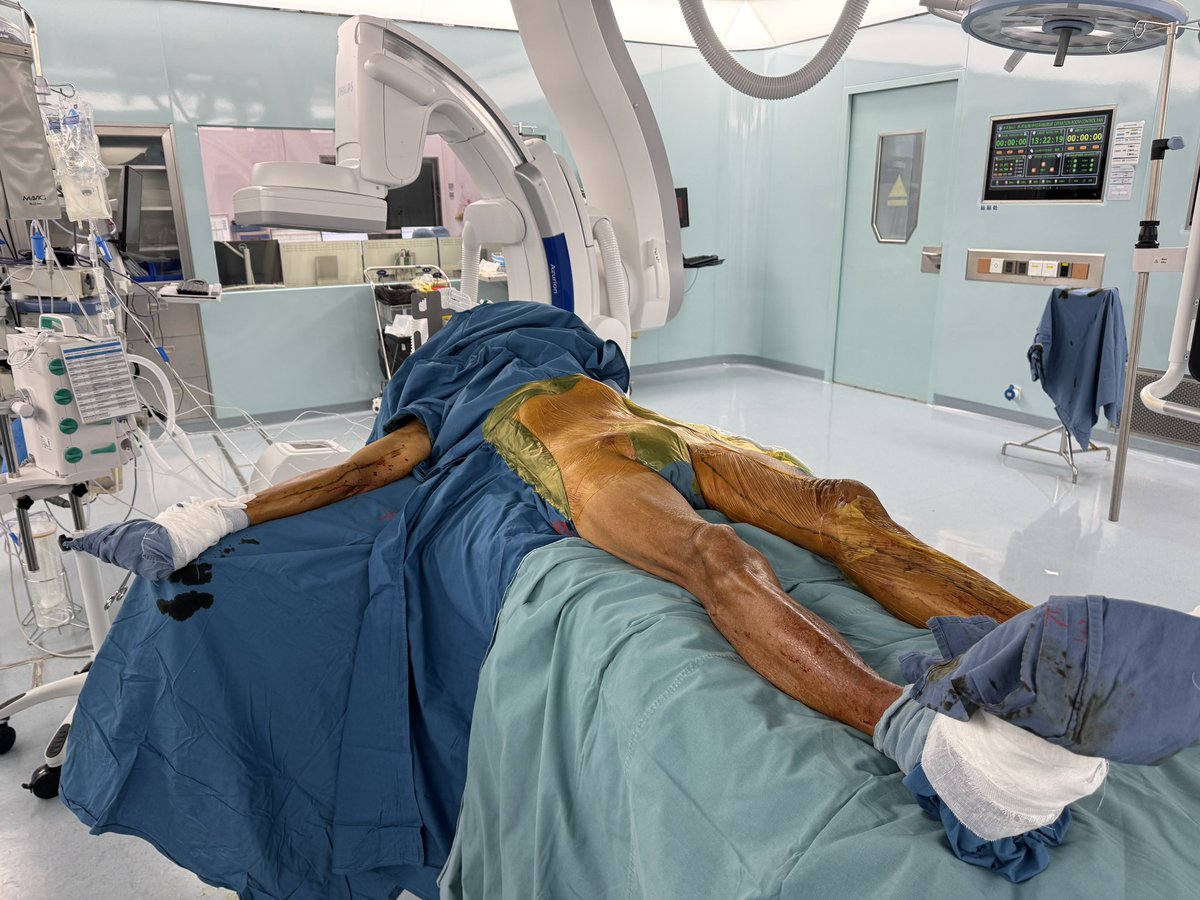 yuejianing's tweet photo. evidence-based revascularization. Rightarm vein and non-reversed GSV from CIA to distal peroneal on the right side, and left arm vein from P1 to post tibial on the left side. #CLTIFighter #limbsalvage https://t.co/vVHdsvhQJ3
