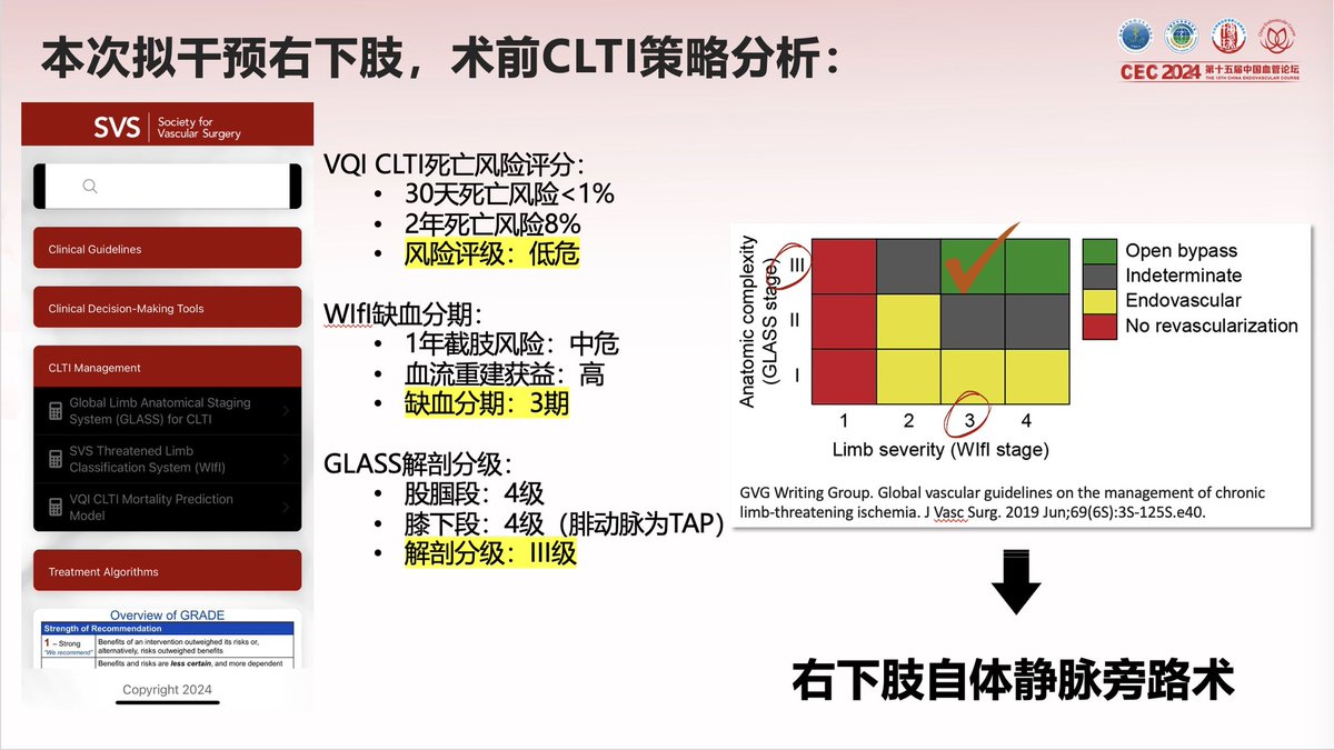 yuejianing's tweet photo. evidence-based revascularization. Rightarm vein and non-reversed GSV from CIA to distal peroneal on the right side, and left arm vein from P1 to post tibial on the left side. #CLTIFighter #limbsalvage https://t.co/vVHdsvhQJ3