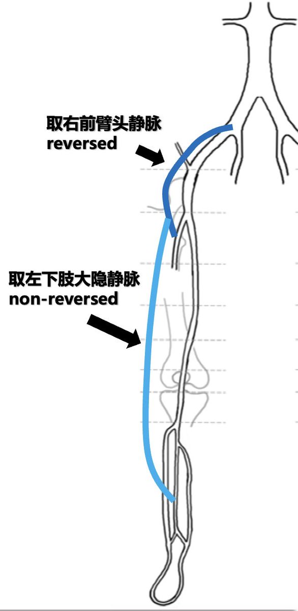 yuejianing's tweet photo. evidence-based revascularization. Rightarm vein and non-reversed GSV from CIA to distal peroneal on the right side, and left arm vein from P1 to post tibial on the left side. #CLTIFighter #limbsalvage https://t.co/vVHdsvhQJ3