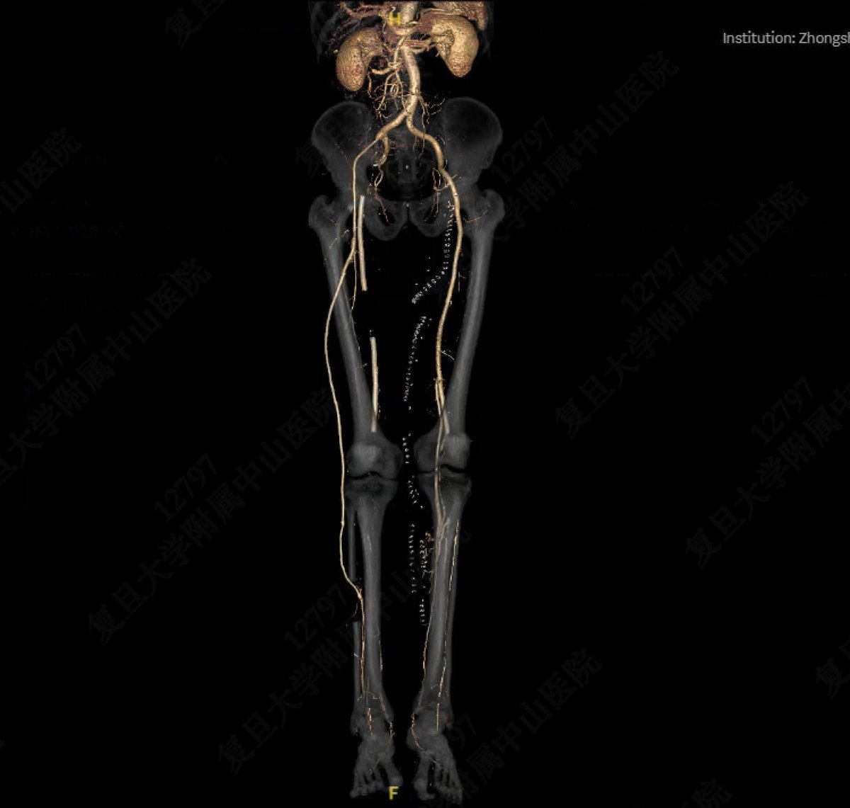 yuejianing's tweet photo. evidence-based revascularization. Rightarm vein and non-reversed GSV from CIA to distal peroneal on the right side, and left arm vein from P1 to post tibial on the left side. #CLTIFighter #limbsalvage https://t.co/vVHdsvhQJ3