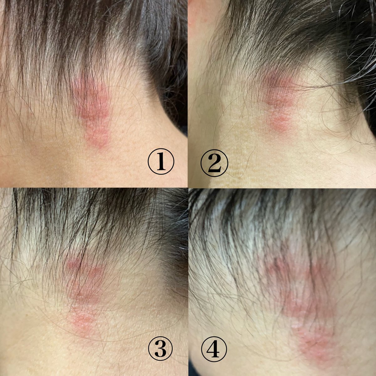 帯状疱疹なう…BBAのうなじWwww
左肩、からだの左半分にピリピリ痛みが
突然走る🏃‍♀💨💨💨のよね~
薬もらってだいぶ良くなったけど…