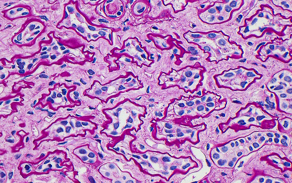 🔬 Renal Tubular Atrophy ~ Tubules with wrinkled and thickened basement membranes and reduced luminal areas ~ #RenalPath #Pathology #Kidney