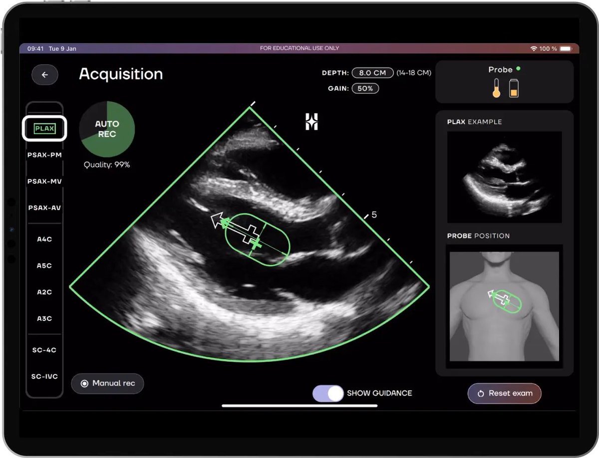 AvelRomanNeph's tweet photo. Probando la nueva App de #IAMarketPlace de #butterflyiQ #HeartFocus que mediante #IA te guía para adquirir imagenes cardiacas de mejor calidad 😱
#Nephrocardiology #INFellow #interventionalNephrology #Echocardioscopy https://t.co/PFpTPYddgl