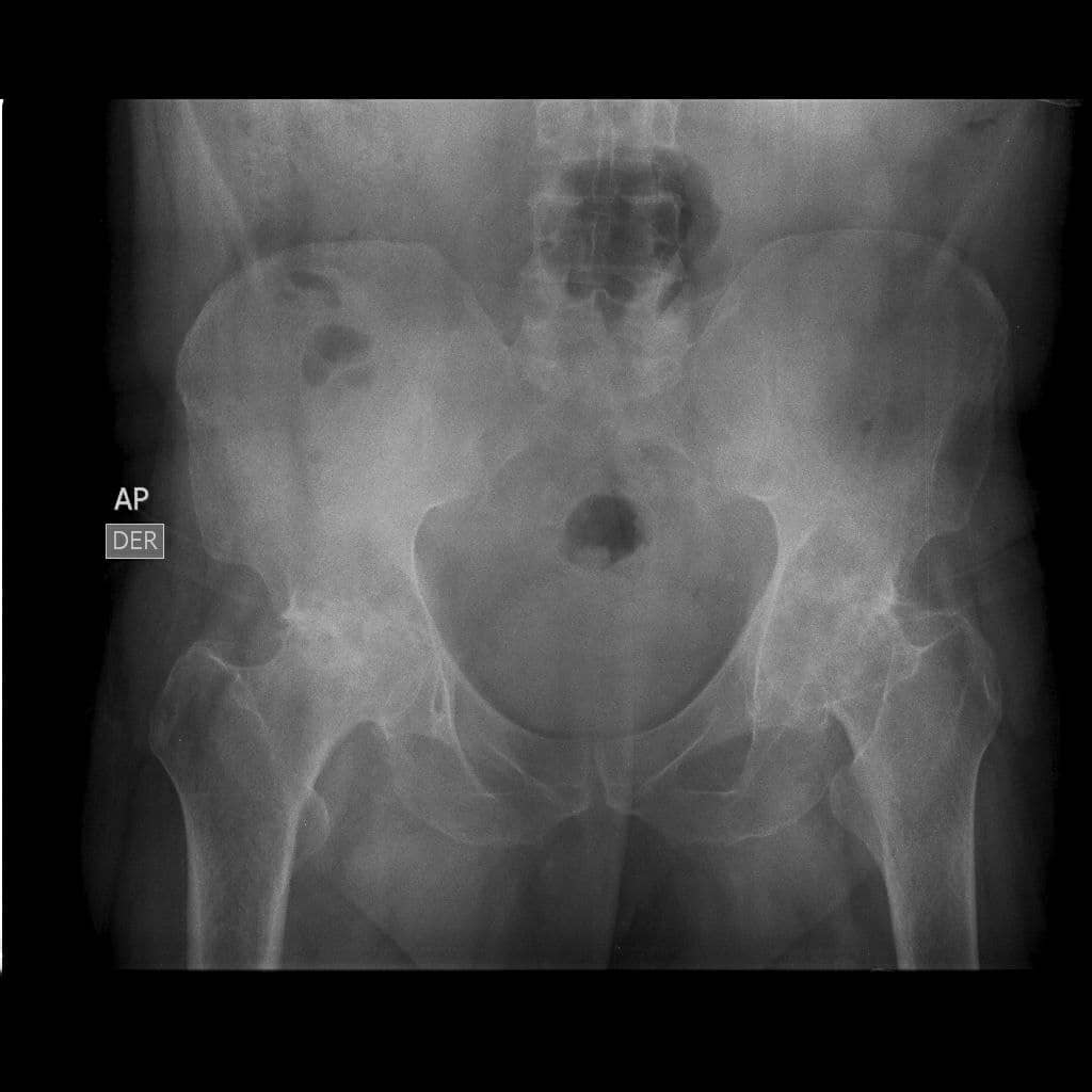 My father has grade III coxarthrosis in both hips and has lost his left femoral head, which causes severe pain and limits his mobility. He needs 2 hip prostheses as he could become disabled. The total cost of both interventions and prosthesis is $22000. Your support is invaluable