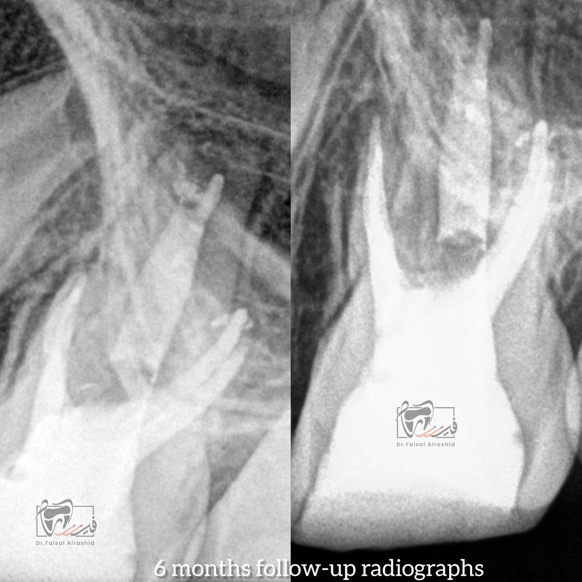 علاج عصب لضرس علوي لطفل
تم علاج ٦ قنوات عصبية ولله الفضل وتمت متابعة الحاله لمدة ٦ أشهر و أبشركم بأنه بأتم صحة و عافية

MB1, MB2, DB1, DB2, and P with a separate portal of exit.

Regarding the P root, what exact condition does it have?

*Sorry about the absence of the other PAs.