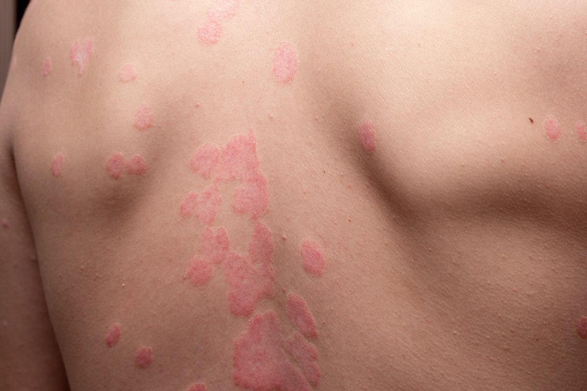 aedv_es's tweet photo. 🗓️ Día Mundial de la Psoriasis 🌍

Este martes, la AEDV y @accionpsoriasis  lanzamos una carta conjunta para concienciar sobre la psoriasis, poniendo a los pacientes en el centro.

 ¡Leed y compartid para promover la mejora en su atención!⬇️

♾️ Carta

#DíaMundialdelaPsoriasis https://t.co/maANwnty9z