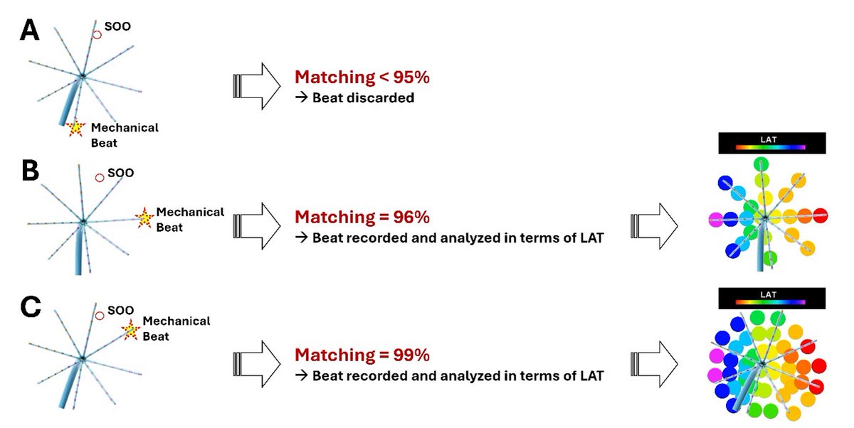 Raphael Martins (@martinsraphae15) on Twitter photo Step 4⃣All the ectopic beats with < 95% of concordance with the clinical PVC are discarded, while those ectopic beats with ≥ 95% of concordance with the clinical PVC are automatically selected by the mapping software, analyzed in terms of LAT and displayed in an activation map Step 4⃣All the ectopic beats with < 95% of concordance with the clinical PVC are discarded, while those ectopic beats with ≥ 95% of concordance with the clinical PVC are automatically selected by the mapping software, analyzed in terms of LAT and displayed in an activation map