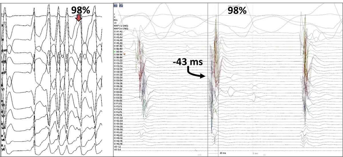 Raphael Martins (@martinsraphae15) on Twitter photo So, it is a LAT map from the ectopic beats generated by the multielectrode catheter!
Since a given spline is generating the ectopic beat, it will display an early EGM starting way before QRS onset. All the EGMs adjacent spline are also analyzed and displayed in the LAT map So, it is a LAT map from the ectopic beats generated by the multielectrode catheter!
Since a given spline is generating the ectopic beat, it will display an early EGM starting way before QRS onset. All the EGMs adjacent spline are also analyzed and displayed in the LAT map