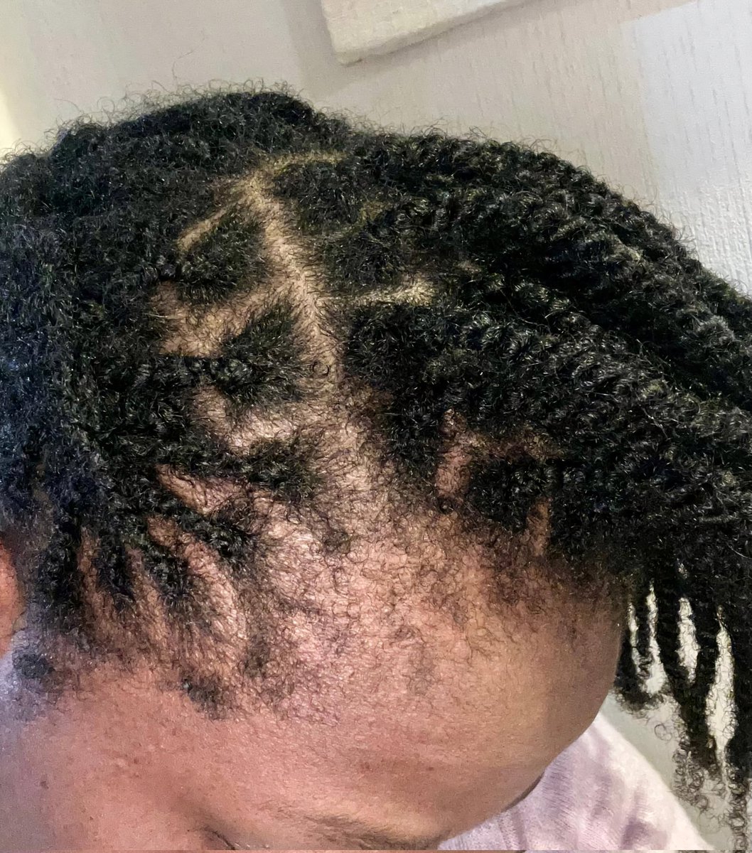 slvhairs's tweet photo. Hello everyone.
I love hair in all it's forms and I would like to share some hair and scalp tips that have worked for me for years.
A lot of people complain about an itchy scalp, and these are some natural remedies that could help: https://t.co/uYHupISrPe