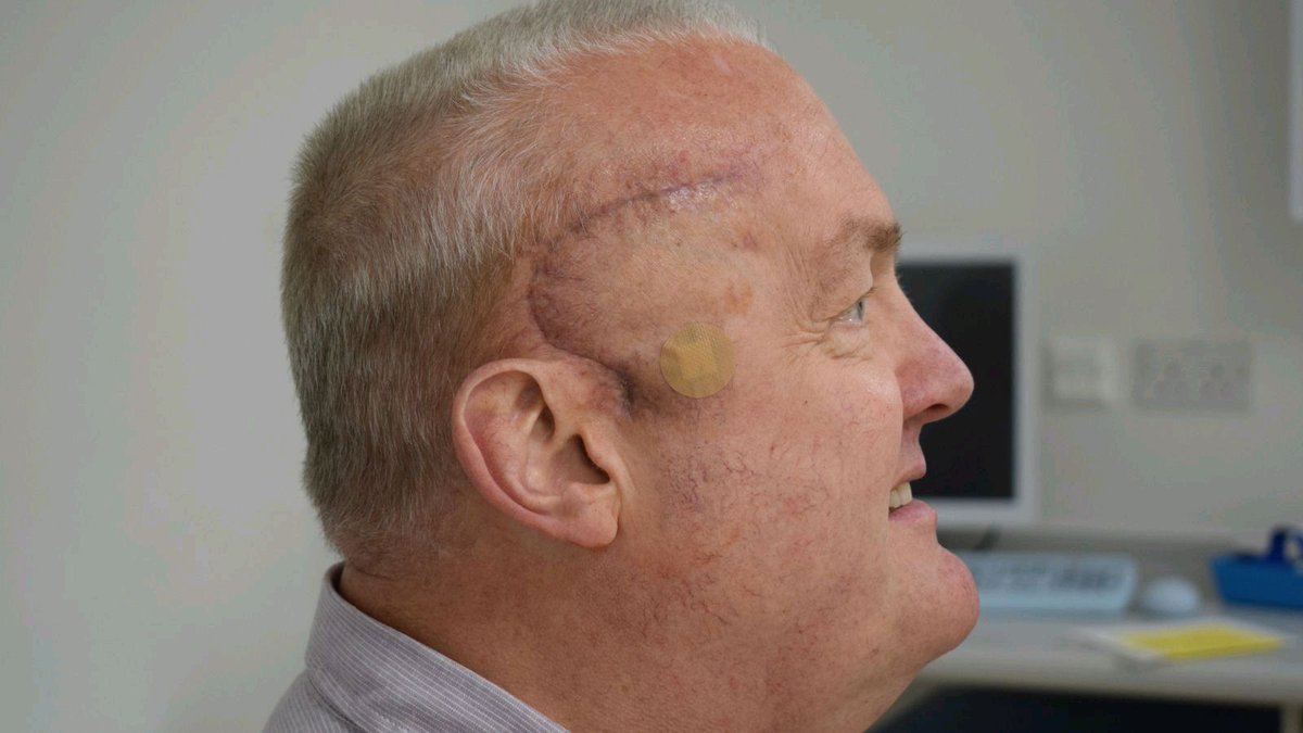 RonnyAllan1's tweet photo. Sky News: New cancer treatment trial shrinks Luton man's brain tumour by half after just weeks of radioactive injections https://t.co/3gZy7j1clB https://t.co/SoA8TXfFV2