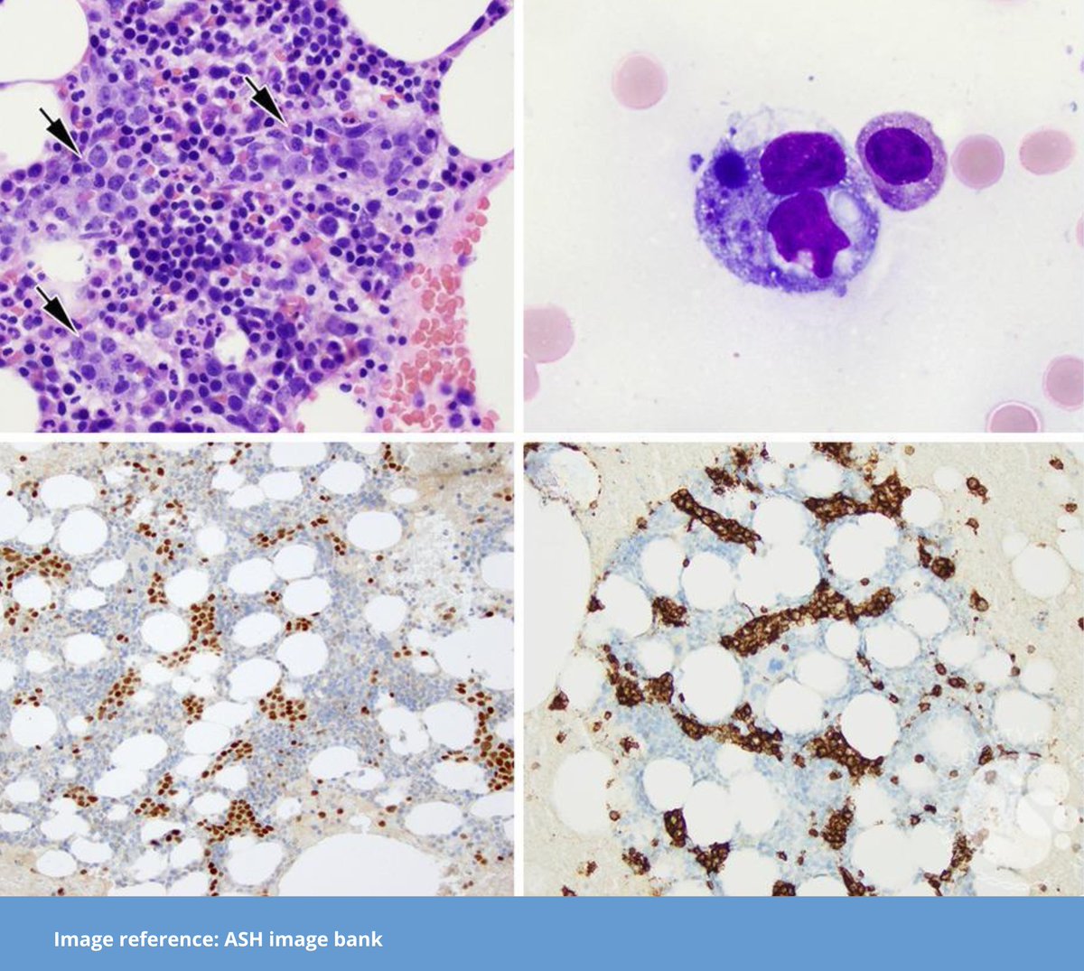 blood_academy's tweet photo. 1/ A 70-year-old man presents with a fever of unknown origin, fatigue, and neurological symptoms mimicking stroke. Imaging shows no lymphadenopathy. What’s the diagnosis (see images)? https://t.co/36Vtu5ZspO