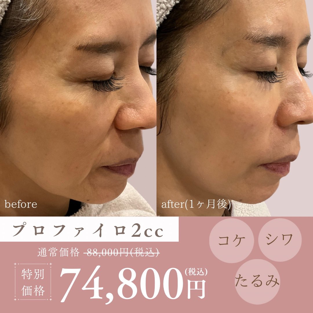 Mclinic_shibuya's tweet photo. 注射1本で若返り💖
肌細胞の再構築を促し皮膚を若返らせる次世代ヒアルロン酸製剤✨
周囲に広がり注入箇所が少ないのもお勧め💉
こめかみの凹みや頬のコケ、小じわ、たるみ改善、ダウンタイムが短く自然な仕上がり💁🏻‍♀️

詳しくはこちら👇
https://t.co/LOr04pZwRO

#profhilo #モニター募集 #渋谷 #女医 https://t.co/QzUQTOL9Cn
