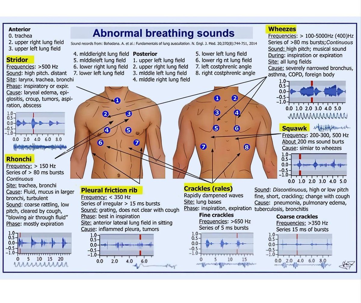 OGdukeneurosurg's tweet image. Abnormal breath sounds