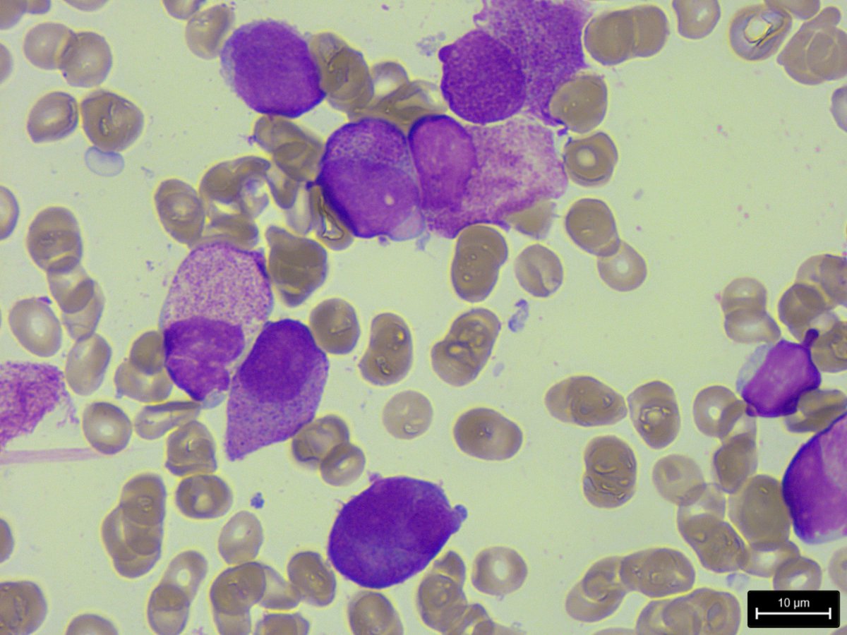 Pour ce remettre en jambe. 
Jeune patiente qui présente depuis 1 semaine :
- Des hématomes spontanés 
- Une asthénie, sans perte de poids
A l'hémogramme, pancytopénie 
Photos de la moelle ci-joint (diag ?)