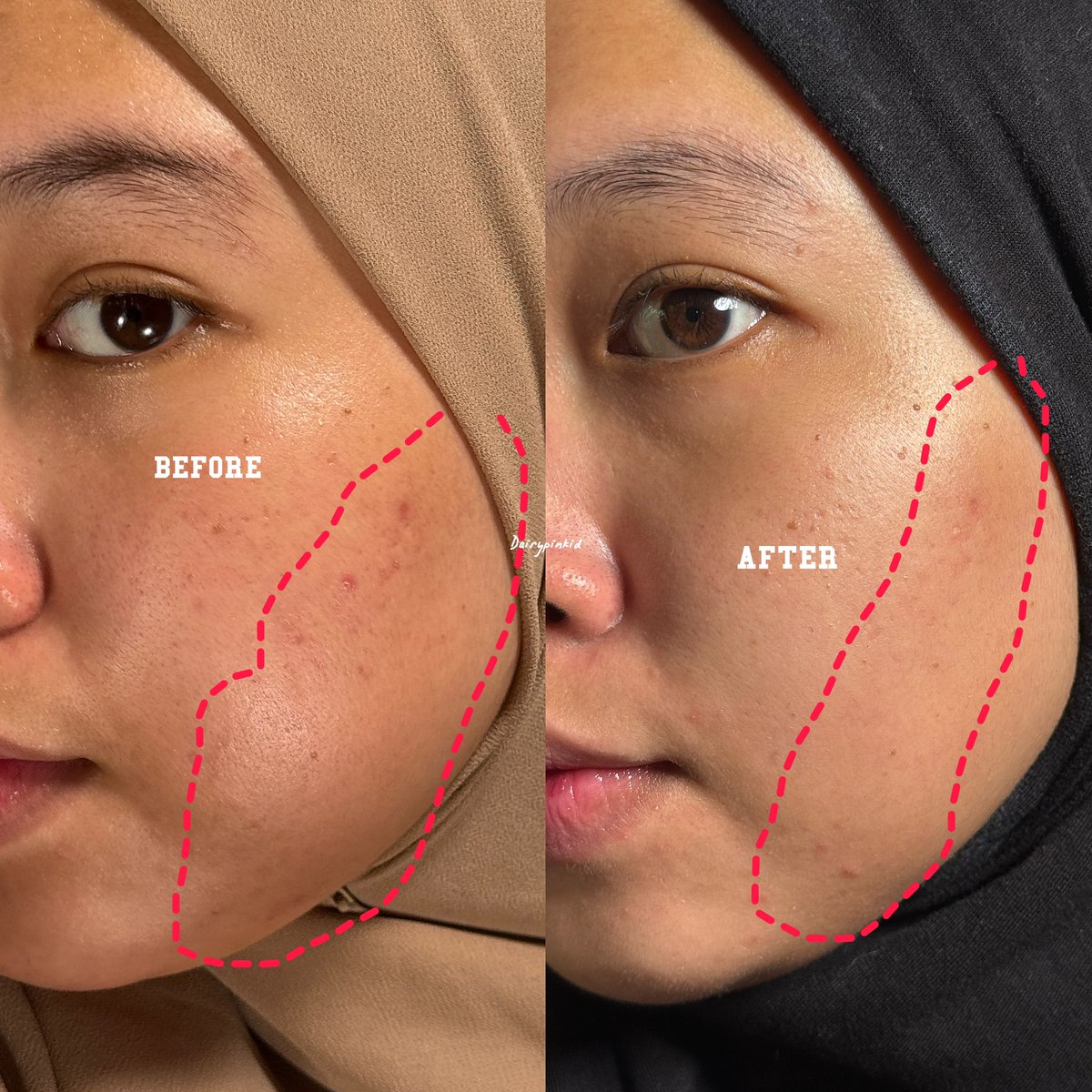 Keknya ini jd serum paling gong dari brand legend viva...20ribuan doang tp ok bgt ternyata???

Beneran bagus.. di kulitku..😭🫵
Dah sisa setengah, siap repuchase😌