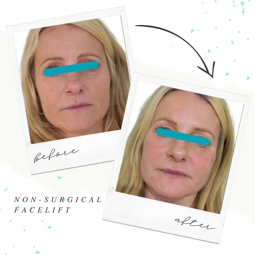 No tricks, just treats! Drop by Hedox Clinic for the best TREATment!

Book your treatment today: DM or visit hedoxclinic.co.uk

#Aesthetics #Aesthetic #Beauty #London #DermalFiller #DermalFillers #skincare #london #marleybone #harleystreet