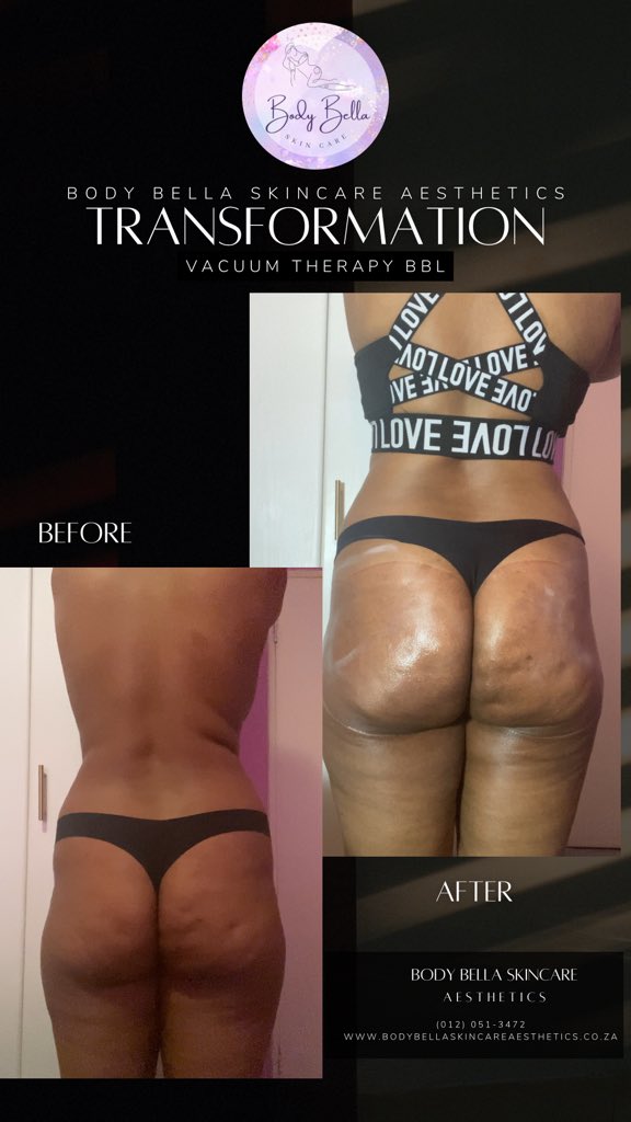 bodybellasa's tweet image. Elevate Your Curves Naturally! 🌟 Experience the benefits of Vacuum Therapy for a fuller, firmer look. Boost your confidence and shape your body today! 💖 #BBL #VacuumTherapy #BodyGoals