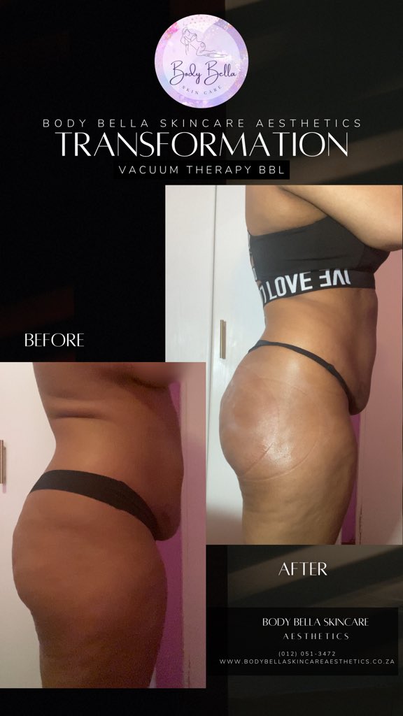 bodybellasa's tweet image. Elevate Your Curves Naturally! 🌟 Experience the benefits of Vacuum Therapy for a fuller, firmer look. Boost your confidence and shape your body today! 💖 #BBL #VacuumTherapy #BodyGoals
