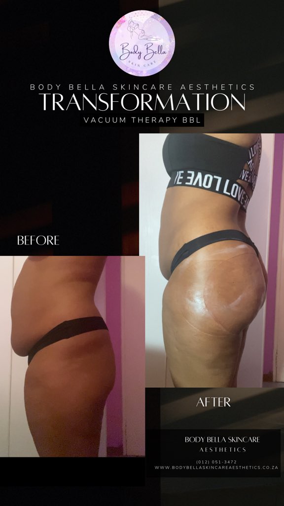 bodybellasa's tweet image. Elevate Your Curves Naturally! 🌟 Experience the benefits of Vacuum Therapy for a fuller, firmer look. Boost your confidence and shape your body today! 💖 #BBL #VacuumTherapy #BodyGoals