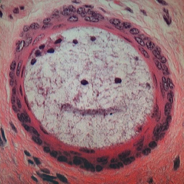 . (@gamonasterioo) on Twitter photo Submandibular salivary gland “hide the pain” duct.
Discovered some time ago by <a href="/JoycevandeVen/">Joyce van de Ven</a> Submandibular salivary gland “hide the pain” duct.
Discovered some time ago by <a href="/JoycevandeVen/">Joyce van de Ven</a>