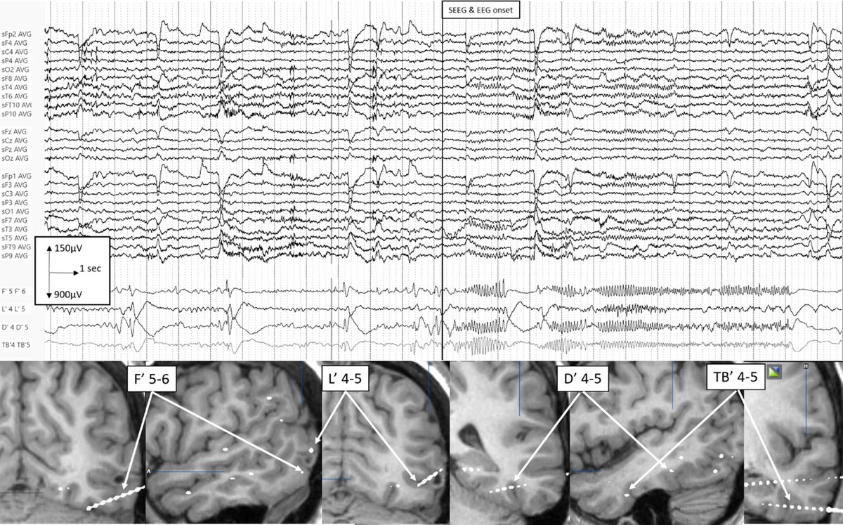 ClinicalNeuroph's tweet photo. [Epilepsy] Cheval et al.: "Scalp EEG accurately determines intra-cerebral seizure onset time in occipital seizures and has good lateralizing value. However, initial scalp modification does not always involves occipital electrodes and the second modification is well lateralizing in only 50 % of seizures."

Open access: https://t.co/dfQwU7N6VX