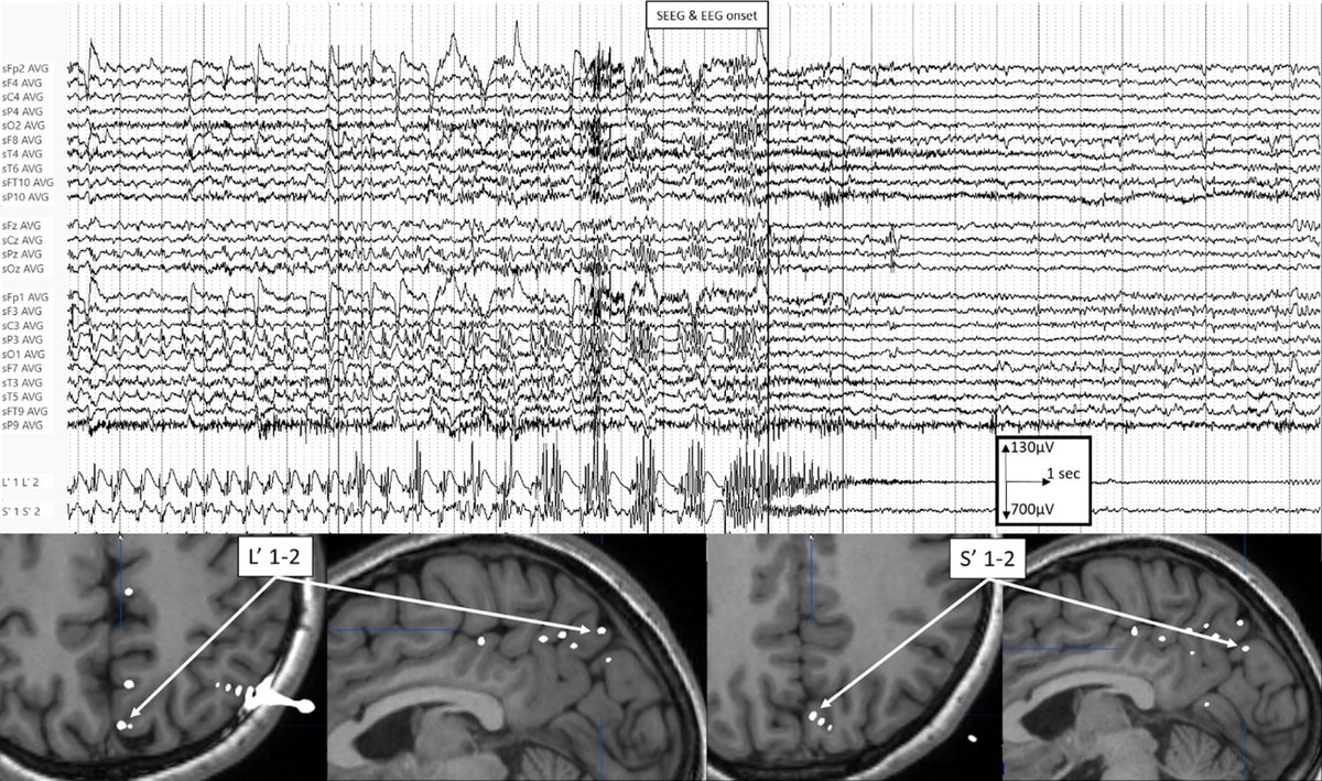 ClinicalNeuroph's tweet photo. [Epilepsy] Cheval et al.: "Scalp EEG accurately determines intra-cerebral seizure onset time in occipital seizures and has good lateralizing value. However, initial scalp modification does not always involves occipital electrodes and the second modification is well lateralizing in only 50 % of seizures."

Open access: https://t.co/dfQwU7N6VX