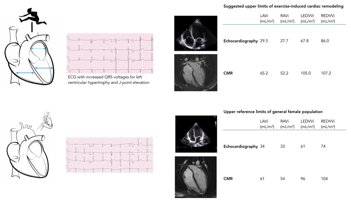 Sports_CardioNL's tweet image. Electrocardiographic and morphological cardiac remodelling in competitive female athletes – a scoping review
academic.oup.com/eurjpc/advance…
#female #Athlete #Cardiacremodelling #SportsCardiology