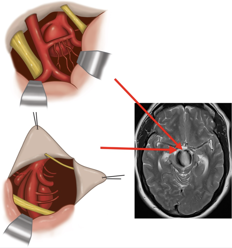 Neurosurgery Publications (@neurosurgerycns) on Twitter photo #ONSNew Subtemporal Approach for the Treatment of Ruptured and Unruptured Distal Basilar Artery Aneurysms: Is There a Contemporary Use? bit.ly/3YEZiNk by Findlay et al <a href="/UofUMedicine/">Spencer Fox Eccles School of Medicine</a> <a href="/jmascite/">Justin R. Mascitelli, MD, FAANS</a> <a href="/LKReedMD/">Laura K. Reed, MD</a> <a href="/DKondziolkaCNS/">Douglas Kondziolka</a> <a href="/george_maragkos/">George Maragkos, MD</a> <a href="/CNS_Update/">CNS</a> #ONSNew Subtemporal Approach for the Treatment of Ruptured and Unruptured Distal Basilar Artery Aneurysms: Is There a Contemporary Use? bit.ly/3YEZiNk by Findlay et al <a href="/UofUMedicine/">Spencer Fox Eccles School of Medicine</a> <a href="/jmascite/">Justin R. Mascitelli, MD, FAANS</a> <a href="/LKReedMD/">Laura K. Reed, MD</a> <a href="/DKondziolkaCNS/">Douglas Kondziolka</a> <a href="/george_maragkos/">George Maragkos, MD</a> <a href="/CNS_Update/">CNS</a>