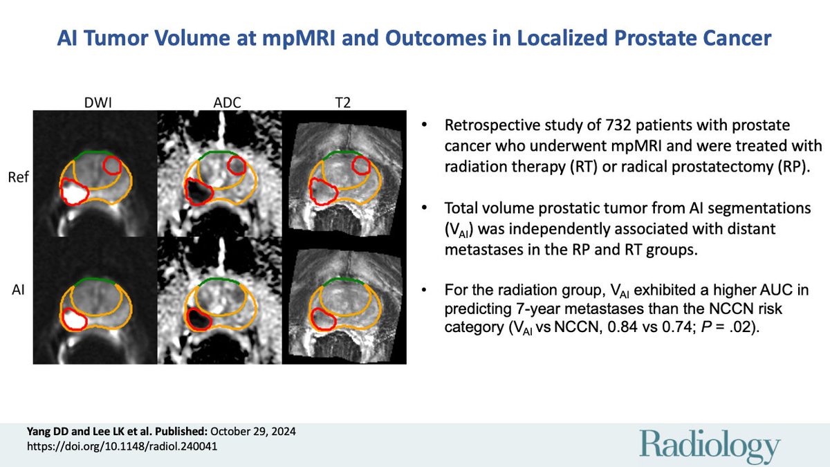 @RadiologyEditor (@radiologyeditor) on Twitter photo 🔍The volume of AI-segmented intraprostatic tumors is an independent prognostic factor for outcomes in localized prostate cancer treated with radical prostatectomy and radiation therapy. Insights from <a href="/DYangMD/">David Yang</a>, <a href="/KatieLeeMDPHD/">Katie Lee</a>, <a href="/MtkingMD/">Martin King</a>, & <a href="/BrighamRadOnc/">Brigham and Women’s Radiation Oncology</a>!
pubs.rsna.org/doi/10.1148/ra… 🔍The volume of AI-segmented intraprostatic tumors is an independent prognostic factor for outcomes in localized prostate cancer treated with radical prostatectomy and radiation therapy. Insights from <a href="/DYangMD/">David Yang</a>, <a href="/KatieLeeMDPHD/">Katie Lee</a>, <a href="/MtkingMD/">Martin King</a>, & <a href="/BrighamRadOnc/">Brigham and Women’s Radiation Oncology</a>!
pubs.rsna.org/doi/10.1148/ra…