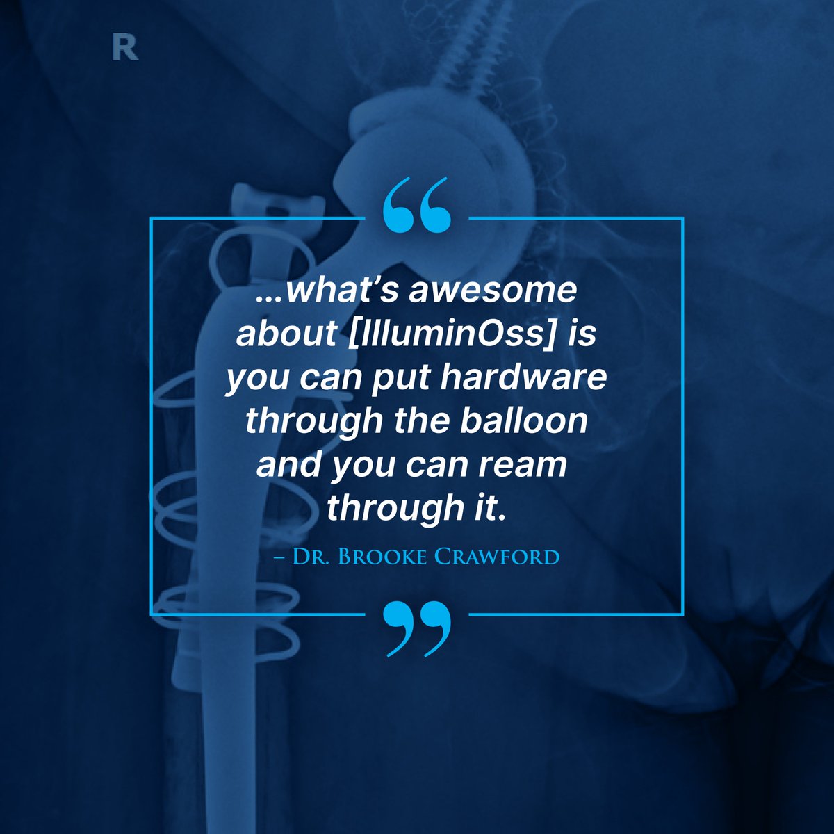 IlluminOss Medical tweet media