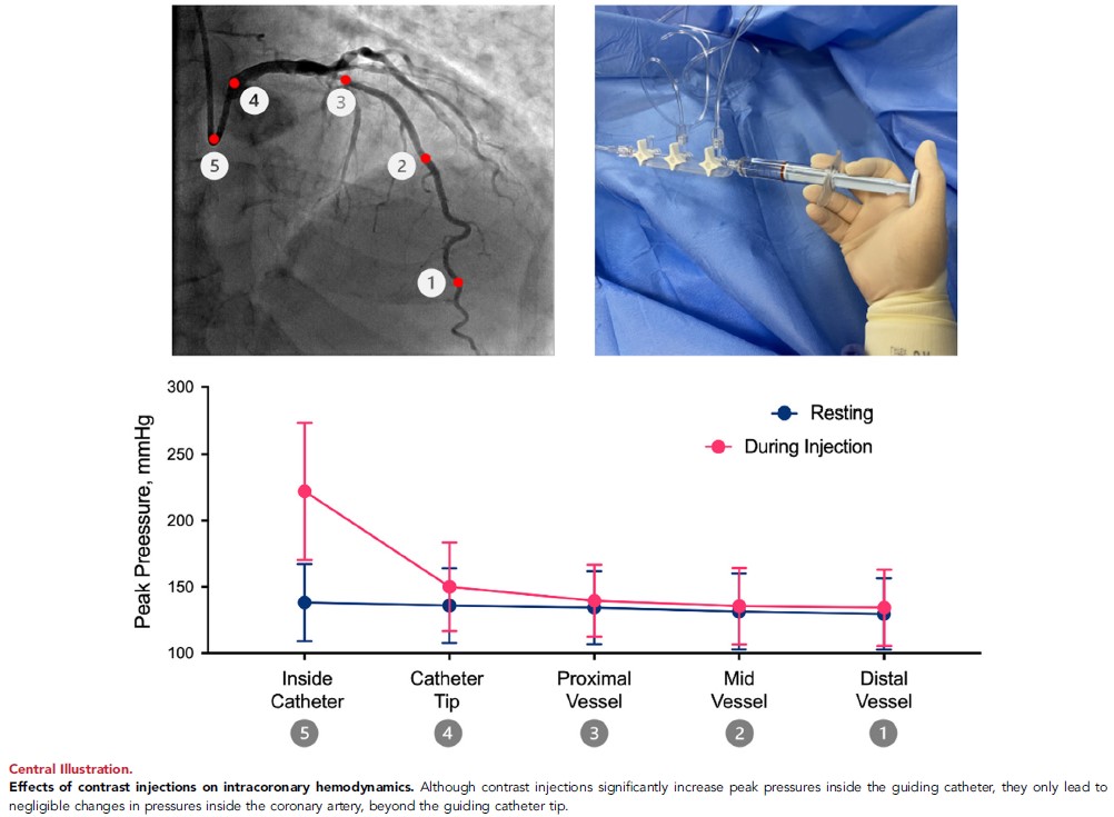 MyJSCAI (@myjscai) on Twitter photo 🆕New Study Alert! 🚨 Can Contrast Injections Cause or Propagate Coronary Injuries? Findings from a prospective, single-arm, multicenter study presented at #TCT2024💥
Read now:
➡️jscai.org/article/S2772-…
<a href="/DanielChamie/">Daniel Chamié</a> <a href="/RicardoPetraco/">Dr Ricardo Petraco 🫀</a> <a href="/mshunshin/">Matthew Shun-Shin</a> <a href="/twj1974/">Tom Johnson</a> <a href="/RahulBahl3/">Rahul Bahl</a> <a href="/rallamee/">Rasha Al-Lamee</a> 🆕New Study Alert! 🚨 Can Contrast Injections Cause or Propagate Coronary Injuries? Findings from a prospective, single-arm, multicenter study presented at #TCT2024💥
Read now:
➡️jscai.org/article/S2772-…
<a href="/DanielChamie/">Daniel Chamié</a> <a href="/RicardoPetraco/">Dr Ricardo Petraco 🫀</a> <a href="/mshunshin/">Matthew Shun-Shin</a> <a href="/twj1974/">Tom Johnson</a> <a href="/RahulBahl3/">Rahul Bahl</a> <a href="/rallamee/">Rasha Al-Lamee</a>