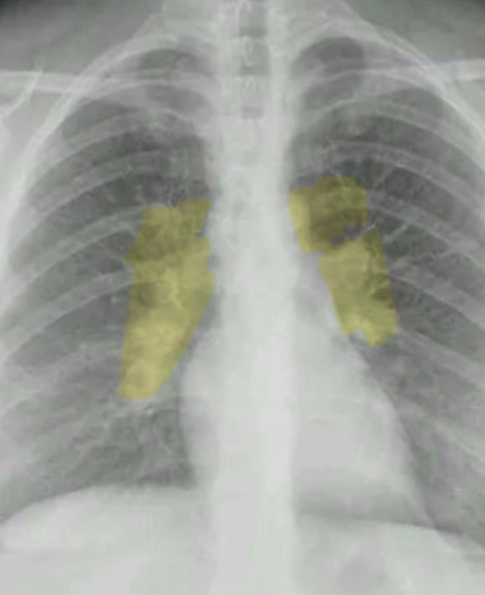 ivvesga's tweet photo. @IhabFathiSulima Symmetrical hilar nodes and a slight paratracheal node, cutaneous lesions resembling erythema nodosum.l

Dx: Sarcoidosis https://t.co/Y16g24GP6m