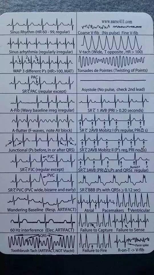 OGdukeneurosurg's tweet photo. EkG basics https://t.co/wPu4OHKiH7